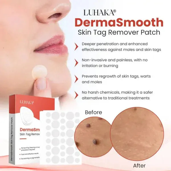 DermaSmooth mole Remover  – Safe & Painless Removal