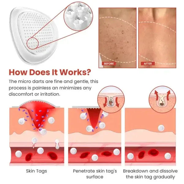 DermaSmooth mole Remover  – Safe & Painless Removal